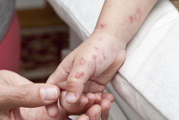 Herpes zoster en la mano de un niño pequeño.