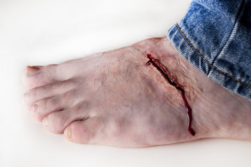 Foot Laceration