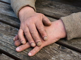 Fungal Nail Infection