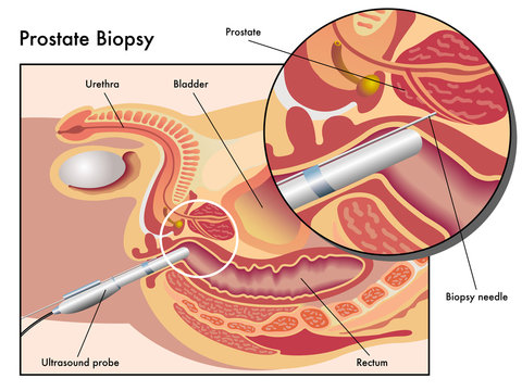 Biopsia prostatica