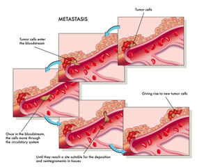 metastasi - obrazy, fototapety, plakaty