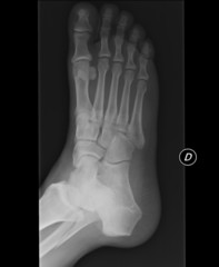 Xray piede