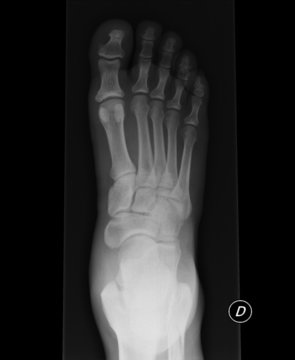 Xray piede