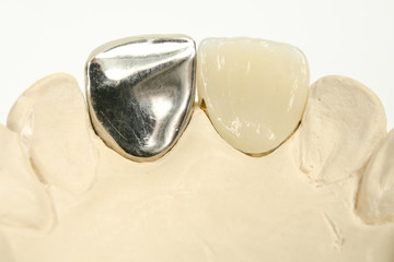 Goldzahn und Keramik vollverblendet, dental © Michael Tieck