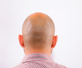 Baldness