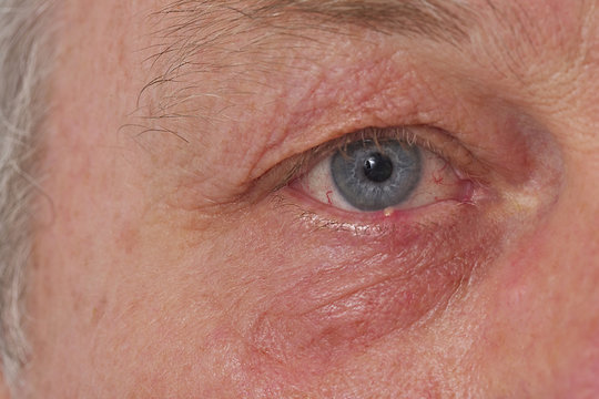 Ophtalmologie - Orgelet ou Chalazion