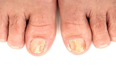 Toenails infected with a fungus