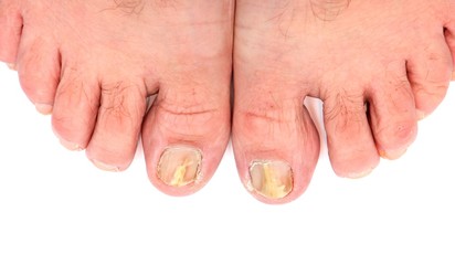 Toenails infected with fungus © DrTI