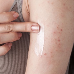 applying an emollient to dry flaky skin
