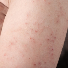 allergic rash dermatitis