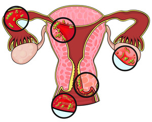 Diseases of female reproductive system
