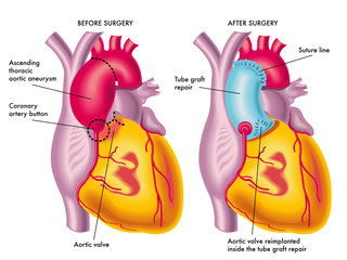 aneurisma aortico toracico - obrazy, fototapety, plakaty