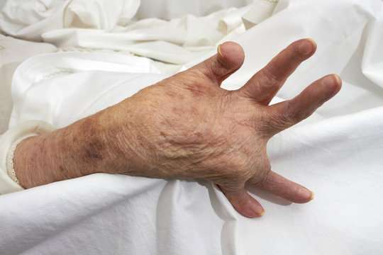 Arthritic Hand