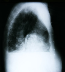 Lung X-ray