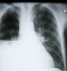 Fototapeta na wymiar RTG płuc