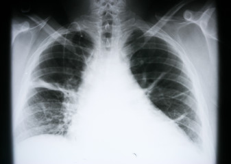 Lung X-ray