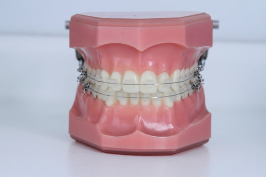 Modelli dentari con apparecchi ortodontici