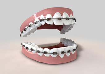Teeth Fitted With Braces