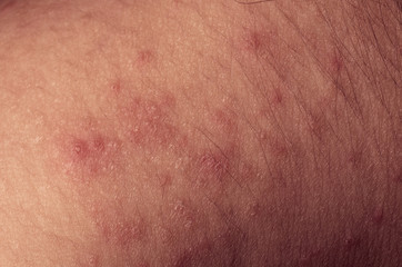 eczema atopic dermatitis symptom skin texture