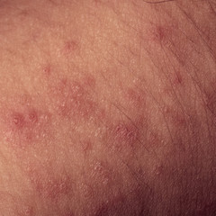 Fototapeta premium eczema atopic dermatitis symptom skin texture