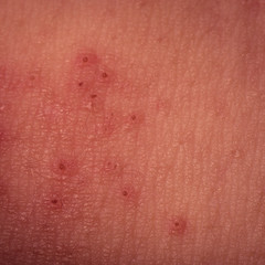 Fototapeta premium eczema atopic dermatitis symptom skin texture