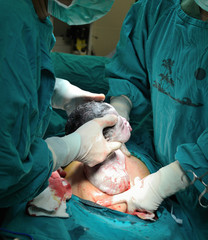 cesarean section