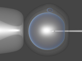 ICSI - Intrazytoplasmatische Spermieninjektion