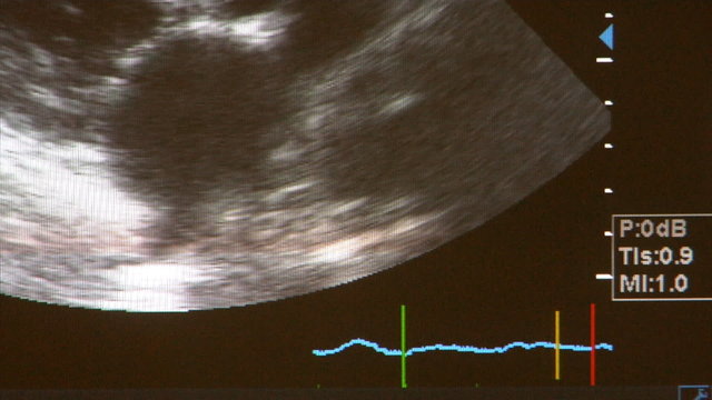 ultrasound scan of childs heart