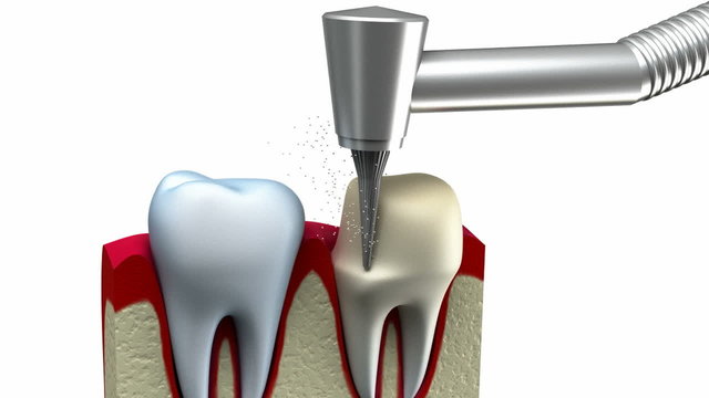 Dental crown installation process