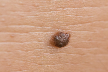 intradermal nevus