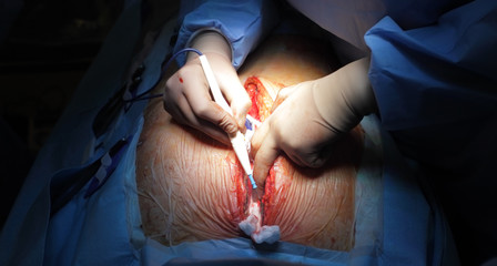 Sternotomy. Treatment of the wound edges.