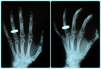 röntgenbild hand