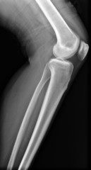 X-ray knee