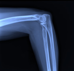 X-ray of the elbow joint.