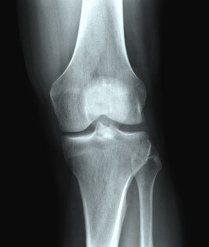 X-ray knee