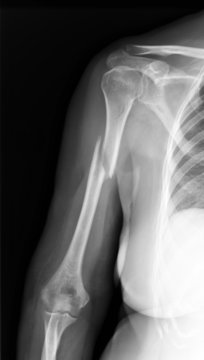 X-ray of broken arm.
