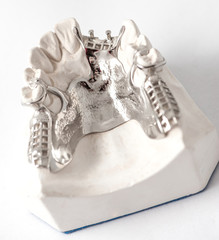 Lower partial denture with attachments