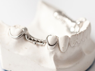 Lower partial denture with attachments