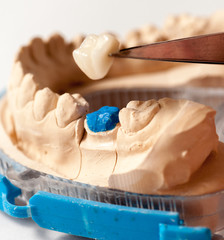 Zirconia Crown, Molar