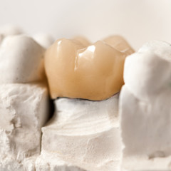 Zirconia Crown, Molar