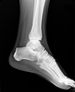 Left foot MRI with toes - X-ray