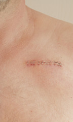 Fototapeta premium pacemaker scar