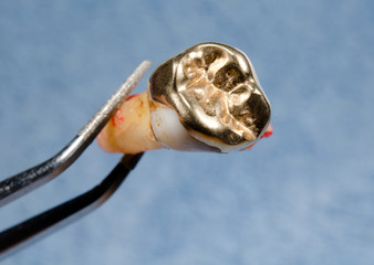 pulled tooth with gold onlay