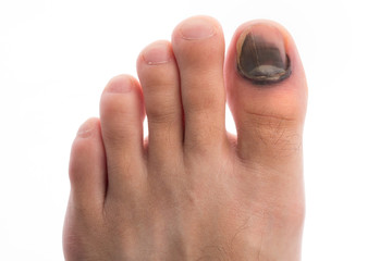Injure Toenail