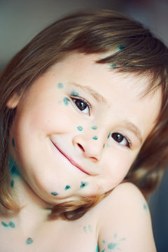 Little Girl With Chickenpox