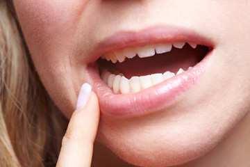 Frau mit Schmerzen am Zahnfleisch