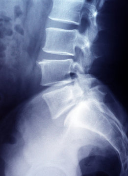Röntgenbild Lendenwirbelsäule - Becken