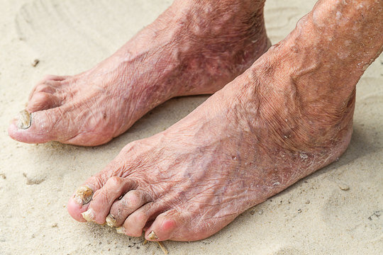 Patients legs of an old woman