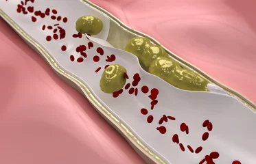  Coronary embolus travels through the circulatory system © CLIPAREA.com
