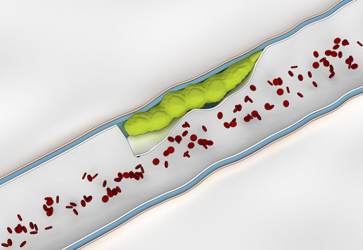 Development Of  Embolus Through The Formation Of Thrombus